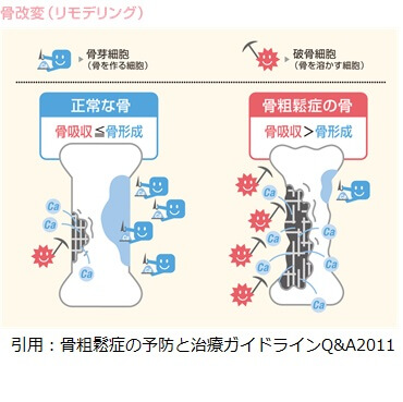 骨のリモデリング