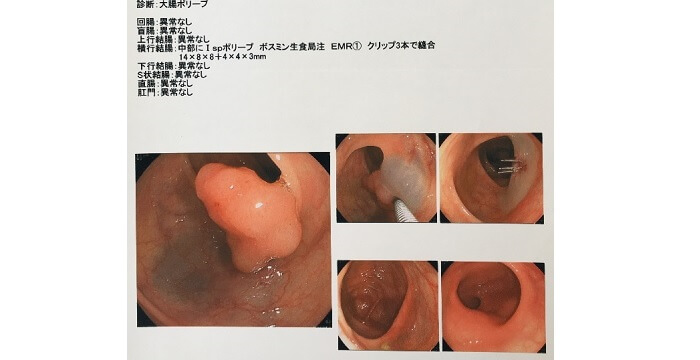 大腸内視鏡検査でポリープ切除